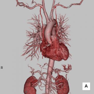 MICS（低侵襲心臓手術）における画像診断