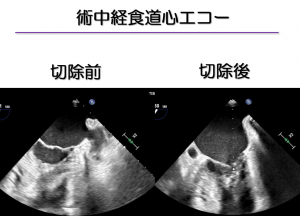 胸腔鏡下左心耳切除術　心房細動の治療です