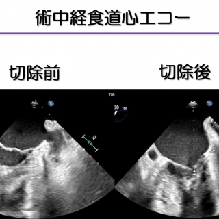 胸腔鏡下左心耳切除術　心房細動の治療です