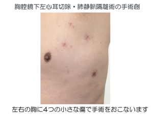 心房細動の治療　胸腔鏡下（内視鏡）左心耳切除術