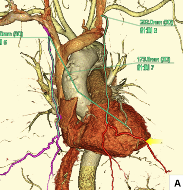 低侵襲冠動脈バイパス術（MICS CABG)の術前評価法