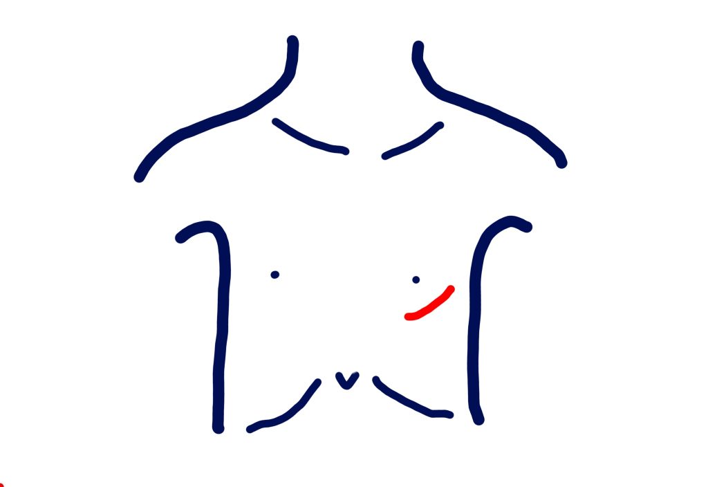 MICS CABGの手術適応について