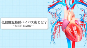 MICS CABGのコラムを書きました